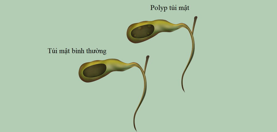 Polyp túi mật: Triệu chứng, nguyên nhân và cách điều trị