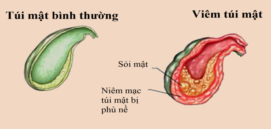 Viêm túi mật: Triệu chứng, nguyên nhân, chẩn đoán và cách điều trị