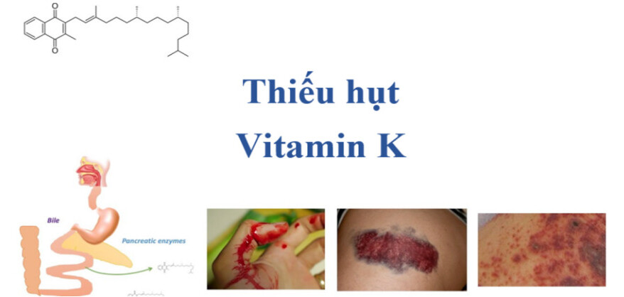 Thiếu hụt vitamin K: Nguyên nhân, triệu chứng và biện pháp điều trị