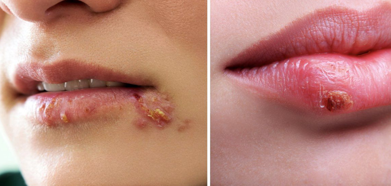 IGG, IGM và xét nghiệm Herpes