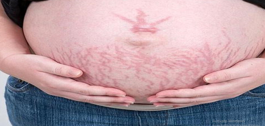 Rạn da trong và sau khi mang thai : Nguyên nhân và biện pháp khắc phục