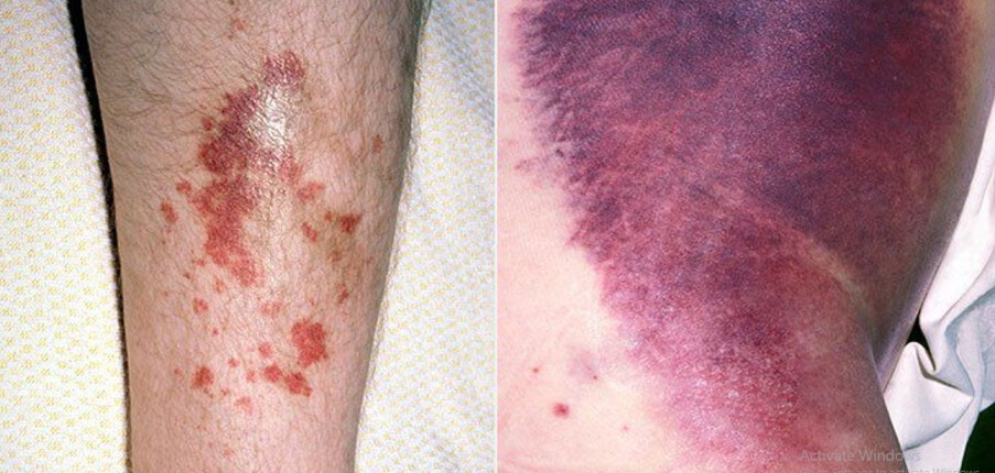 Xuất huyết dưới da có nguy hiểm không? Nguyên nhân và cách điều trị
