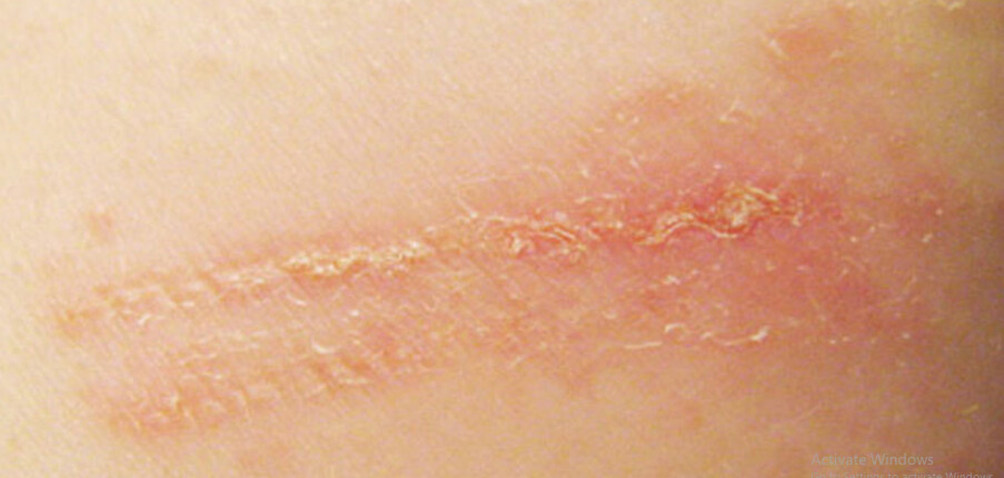 Bệnh viêm da tiếp xúc là gì? Nguyên nhân và biện pháp điều trị