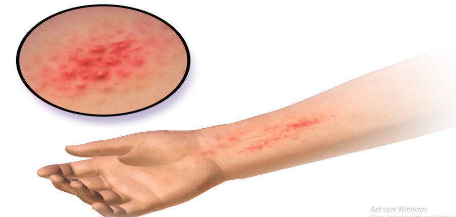 Viêm da tiếp xúc dị ứng: Nguyên nhân, triệu chứng, điều trị và phòng ngừa