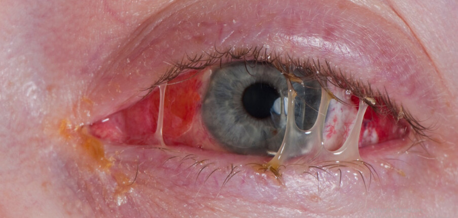 Đau mắt đỏ (viêm kết mạc): Nguyên nhân, điều trị và cách phòng tránh