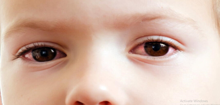 Đau mắt đỏ (viêm kết mạc) ở trẻ em có lây không? Nguyên nhân, dấu hiệu nhận biết và điều trị