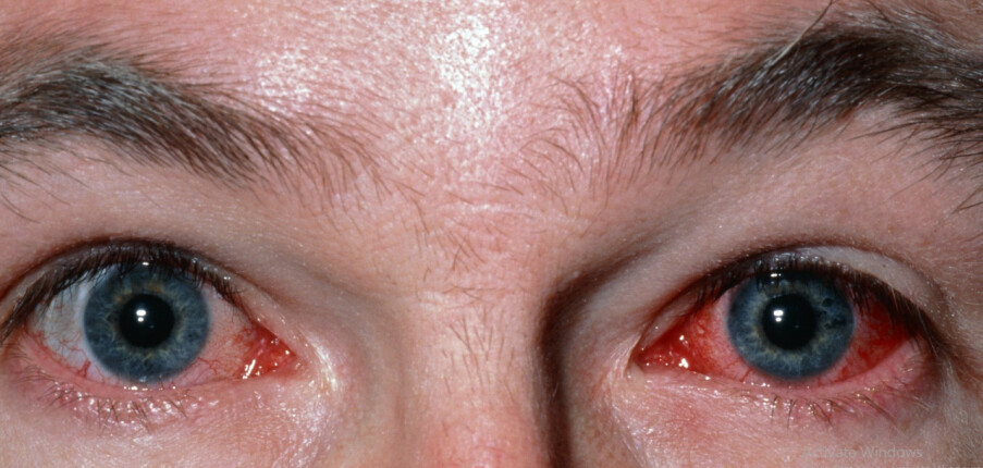 Đau mắt đỏ (viêm kết mạc): làm sao để nhanh khỏi?