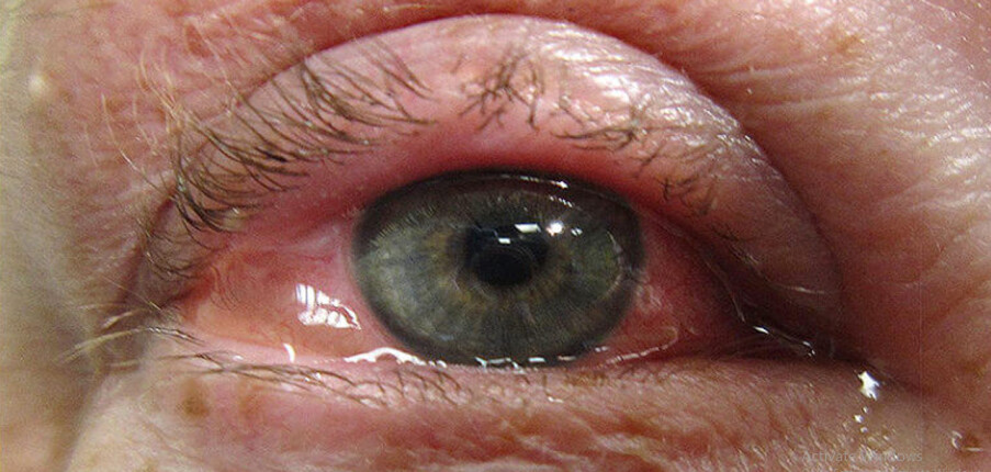 5 biện pháp chữa đau mắt đỏ (viêm kết mạc) tại nhà hiệu quả