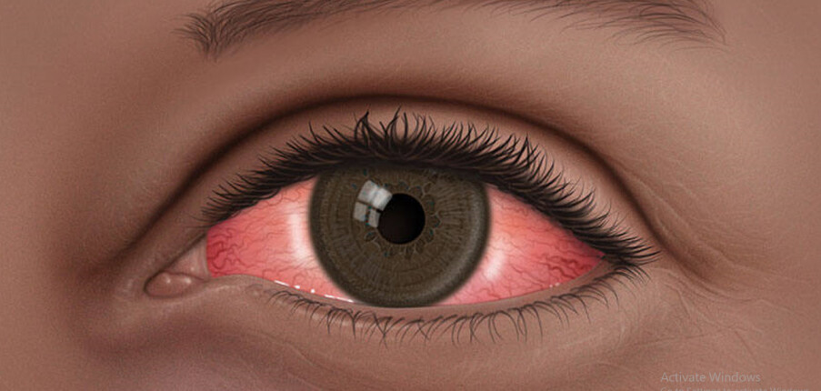 Chữa đau mắt đỏ (viêm kết mạc) bằng các biện pháp dân gian có thực sự hiệu quả không?