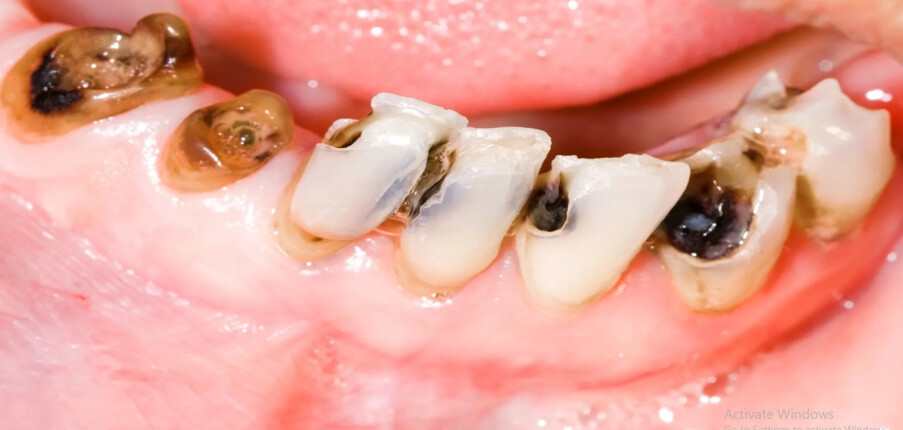 Sâu răng: Các giai đoạn và phương pháp điều trị