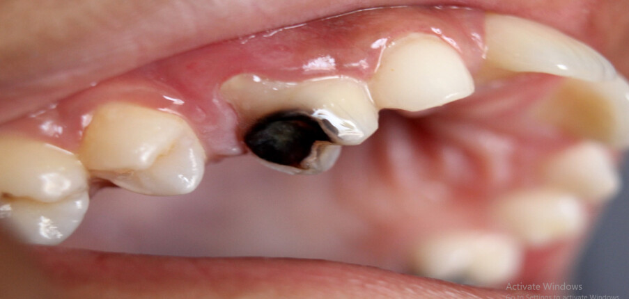 Sâu răng: Cách nhận biết, nguyên nhân, điều trị và phòng ngừa