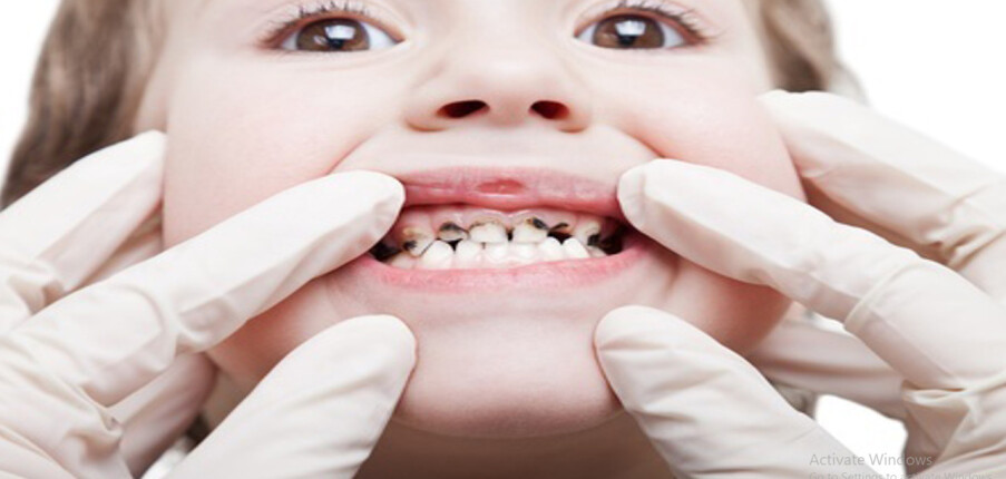 Ngăn ngừa sâu răng ở trẻ nhỏ
