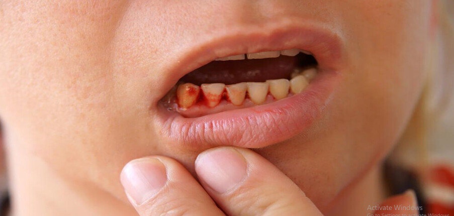 Chảy máu chân răng: Nguyên nhân và biện pháp điều trị