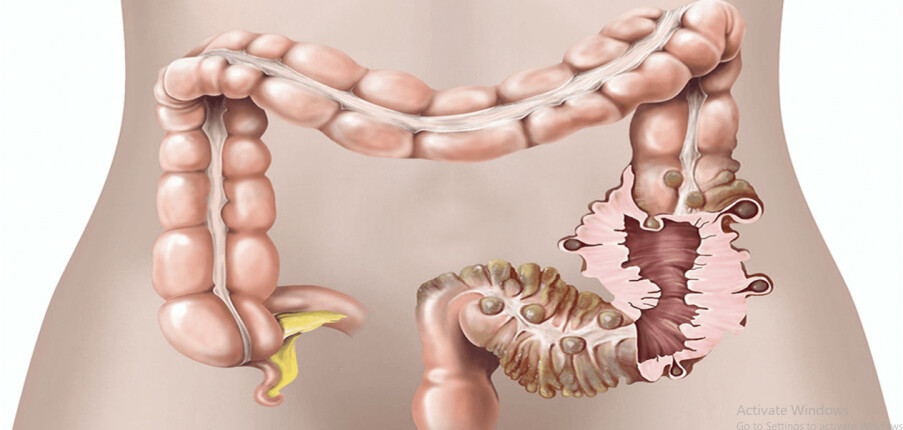Bệnh túi thừa và viêm túi thừa đại tràng: Triệu chứng, nguyên nhân, điều trị và tiên lượng