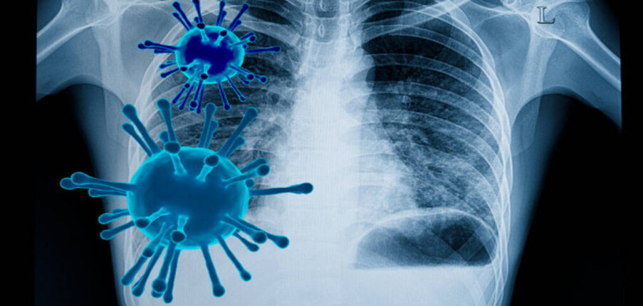 7 điều cần biết về viêm phổi không điển hình