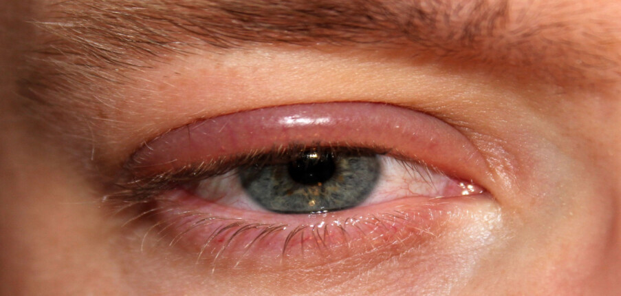 Viêm mí mắt (viêm bờ mi): Nguyên nhân, triệu chứng, chẩn đoán, điều trị và phòng bệnh