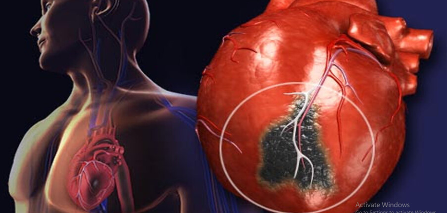 Nhồi máu cơ tim: Nguyên nhân, dấu hiệu nhận biết và hơn nữa