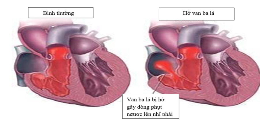 Hở van ba lá: Triệu chứng, nguyên nhân và biện pháp điều trị