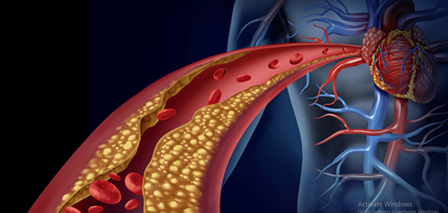 Bệnh thiếu máu cơ tim: Nguyên nhân, triệu chứng, biến chứng và điều trị