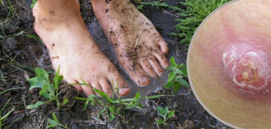 Bệnh Melioidosis (bệnh Whitmore): Triệu chứng, nguyên nhân, điều trị và phòng ngừa