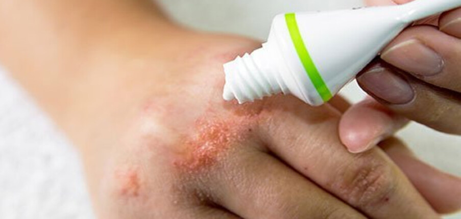 Những điều cần biết về thuốc chữa eczema và viêm da