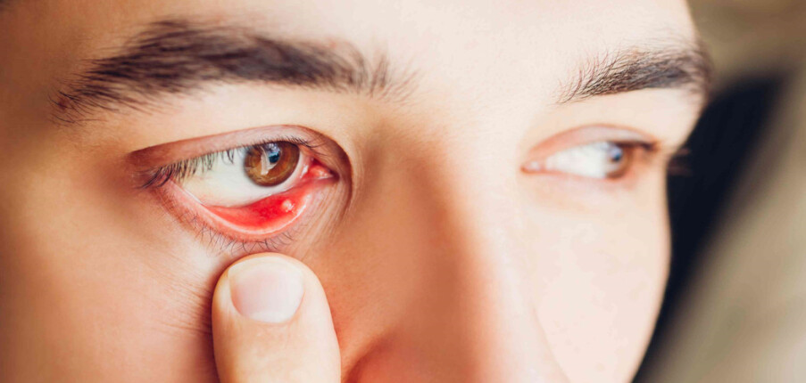 Lẹo mắt: Nguyên nhân, phòng ngừa và điều trị