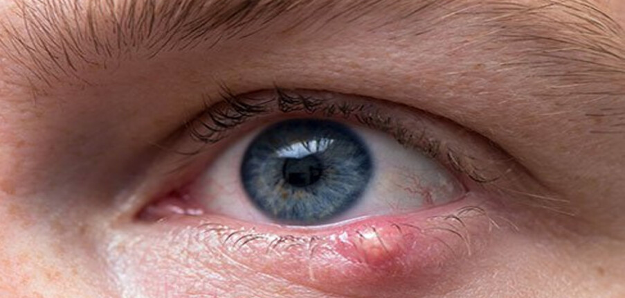 7 cách điều trị lẹo mắt hiệu quả nhất