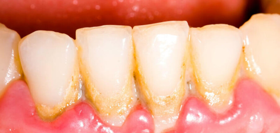 Sự khác biệt giữa mảng bám và cao răng