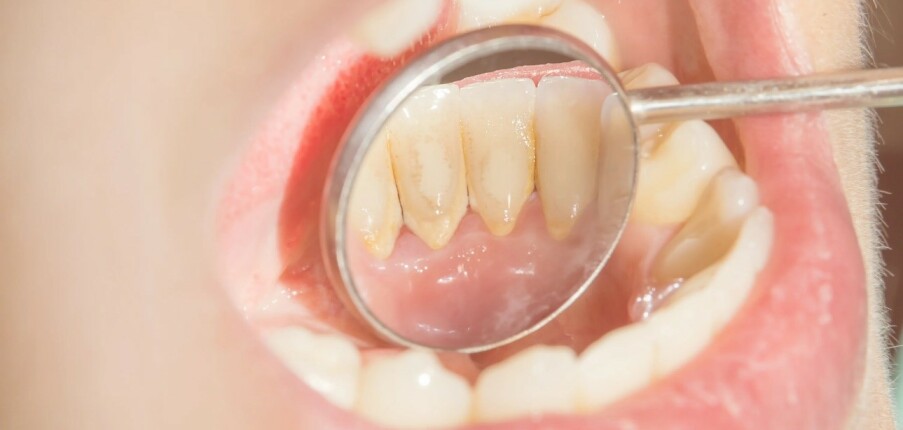Cao răng, mảng bám: Các biện pháp tự nhiên để làm sạch tại nhà