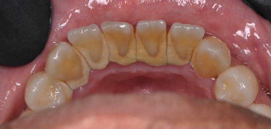 Cao răng: Biện pháp ngăn ngừa hình thành cao răng