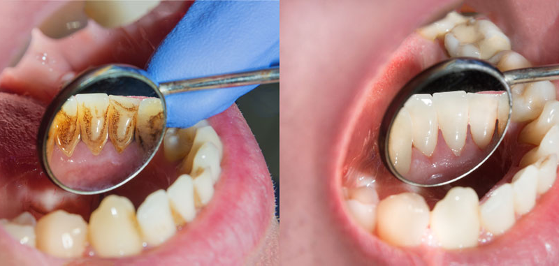 6 bước cụ thể của quy trình lấy cao răng