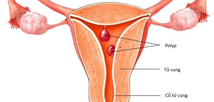 Polyp tử cung: Nguyên nhân, triệu chứng, chẩn đoán và điều trị
