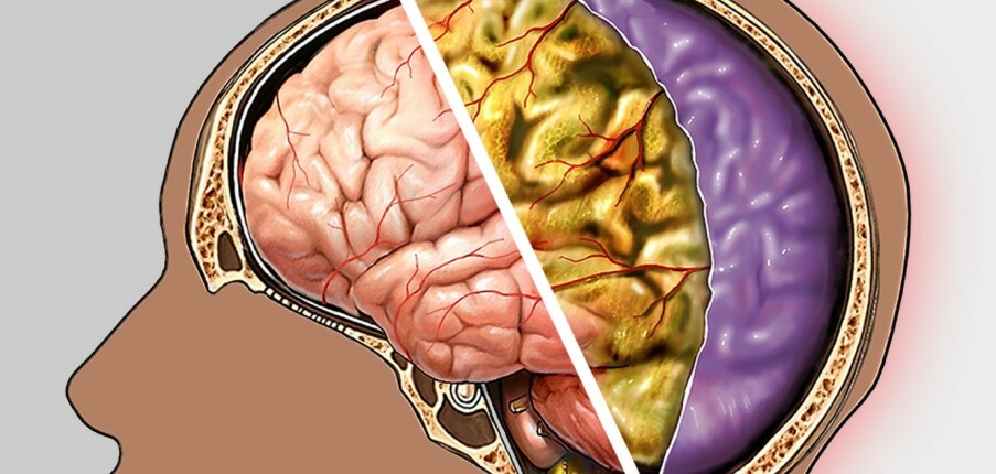 Bệnh viêm màng não: Triệu chứng, nguyên nhân, phân loại và điều trị