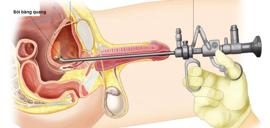 Phương pháp tán sỏi nội soi bàng quang và những điều cần biết