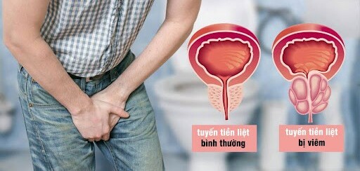 Viêm tuyến tiền liệt: Phân loại và các biện pháp điều trị