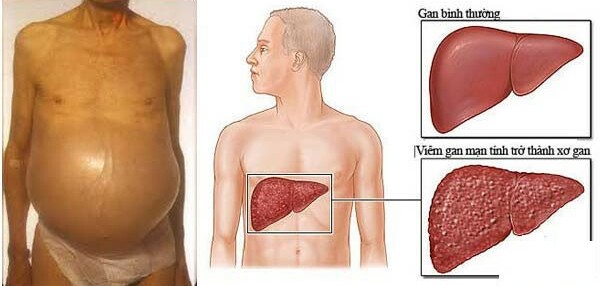 Tất cả những gì cần biết về xơ gan: Dấu hiệu, phân loại, biến chứng, nguyên nhân và phương pháp điều trị