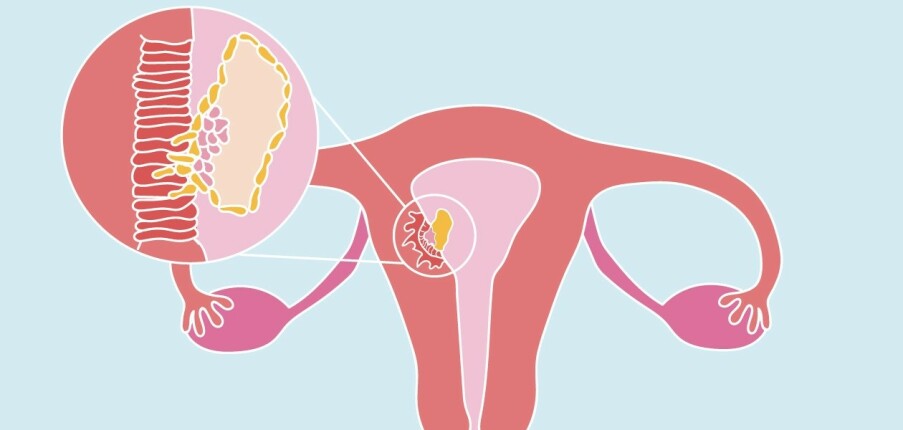 Thai vào tử cung: Triệu chứng, mốc thời gian, thời điểm đi khám