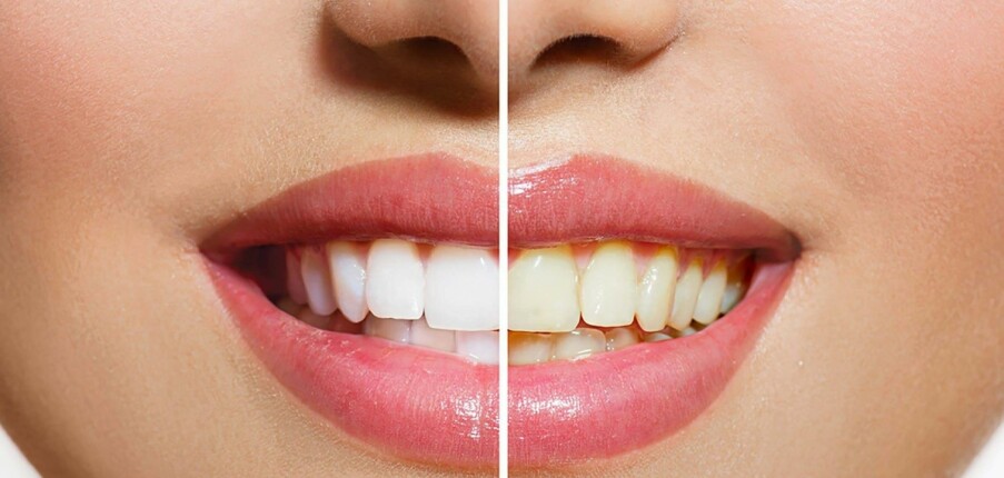 Làm trắng răng: các loại sản phẩm, cơ chế, hiệu quả và tính an toàn