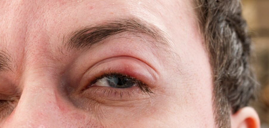 Đau mắt hột: Nguyên nhân, triệu chứng, chẩn đoán và điều trị