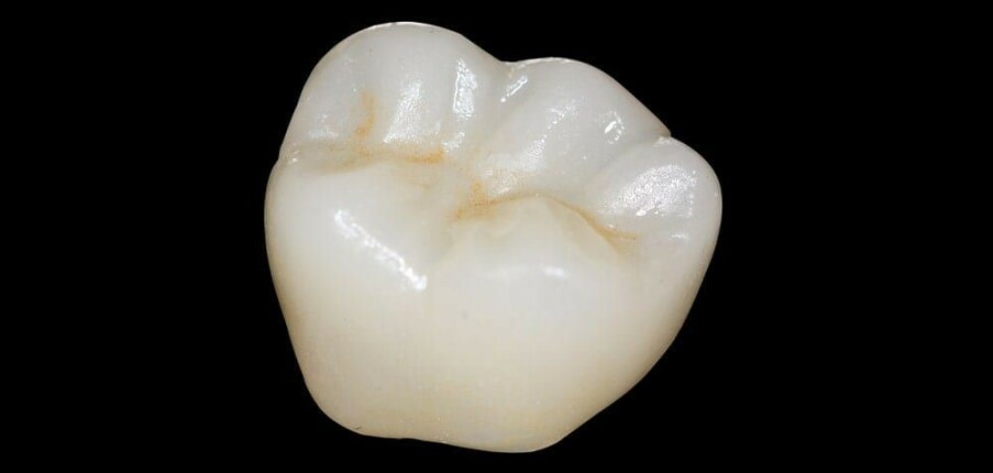 Những điều cần biết về mão răng Zirconia