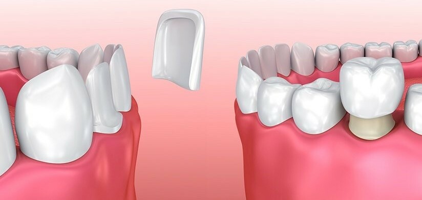 Veneer và mão răng: Sự khác biệt và cái nào phù hợp với bạn?
