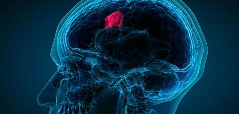 U não: Phân loại, triệu chứng, chẩn đoán và điều trị