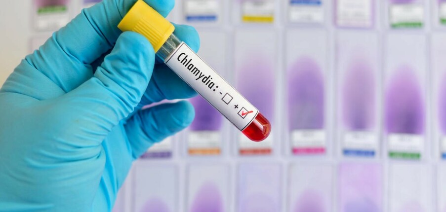 Xét nghiệm chẩn đoán Chlamydia: Những điều bạn cần biết
