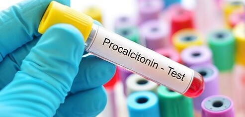 Xét nghiệm procalcitonin (Pct) là gì? Mục đích, quy trình và kết quả