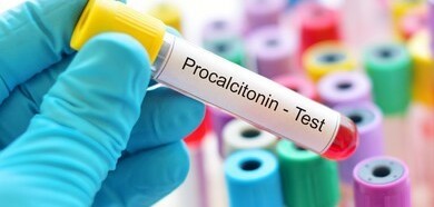 Xét nghiệm procalcitonin (pct) chẩn đoán nhiễm trùng huyết