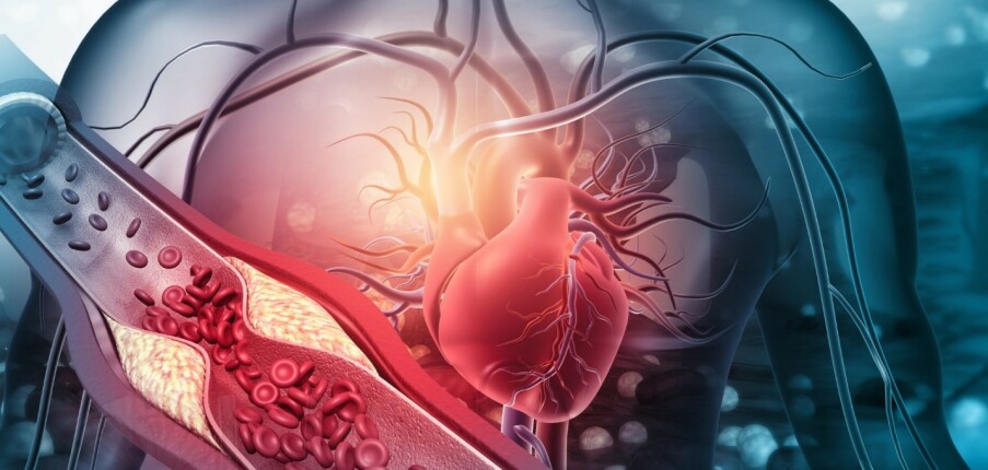 Xơ vữa động mạch: Nguyên nhân, triệu chứng, chẩn đoán và điều trị