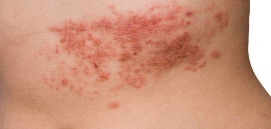 21 nguyên nhân hàng đầu khiến da nổi mẩn đỏ và biện pháp điều trị