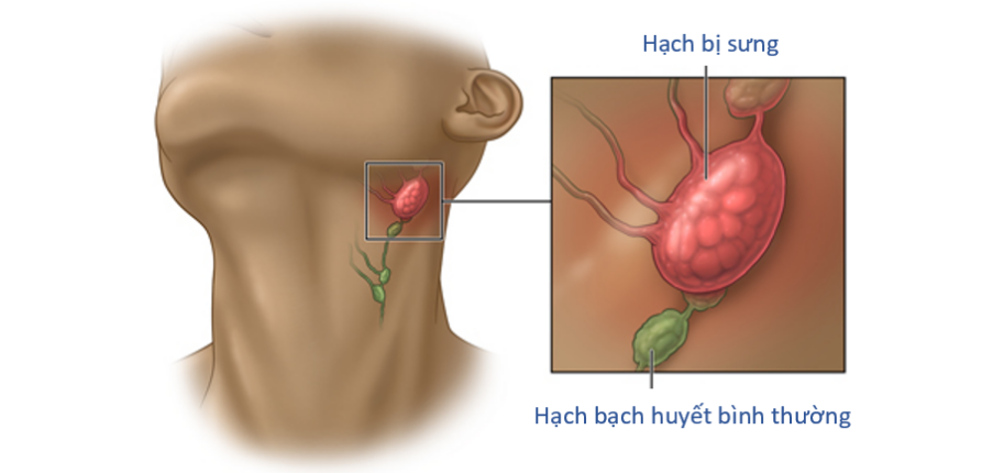 Sưng hạch bạch huyết: Nguyên nhân, chẩn đoán và điều trị