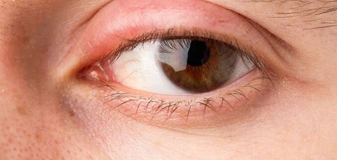 12 nguyên nhân gây sưng mí mắt thường gặp và cách điều trị