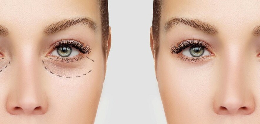 17 cách giúp loại bỏ bọng mắt hiệu quả nhất